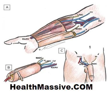 Why You Should Avoid Phalloplasty at All Costs