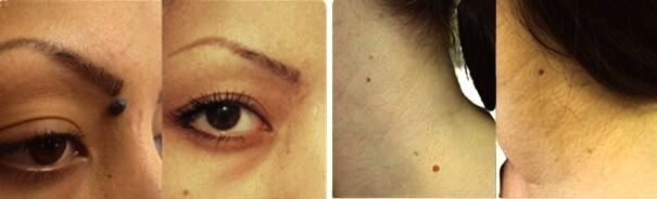 Amarose Skin Tag Remover Before And After